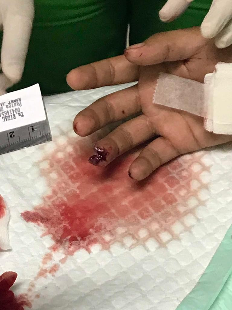 Niat Antar Pacar Pulang, Jari Rizal Kena Tembak Oleh Oknum Polisi